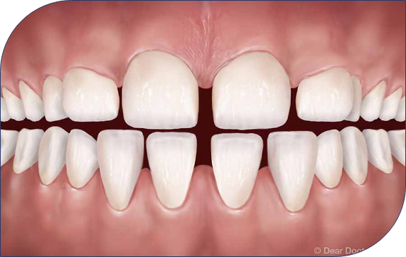 Spacing and Diastema Correction 