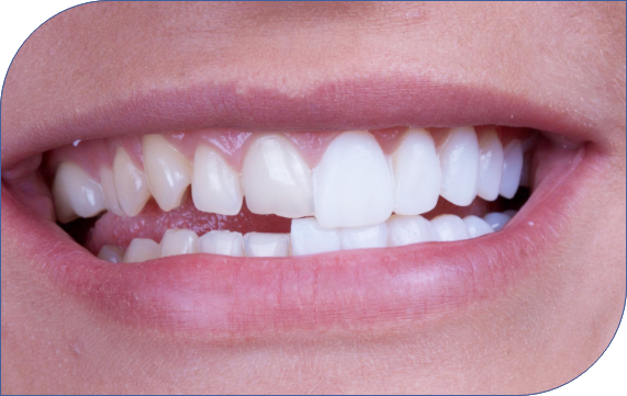 Porcelain Veneers