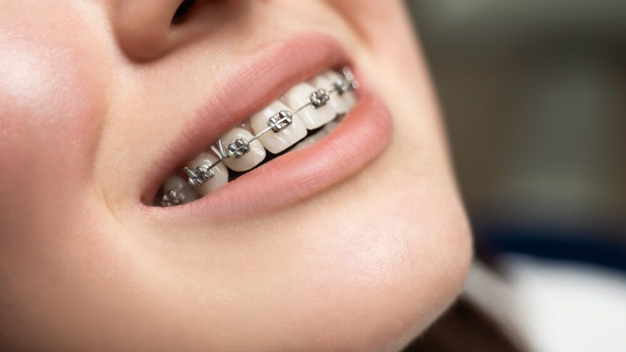 Braces Unveiled: A Journey to Straighter Smiles