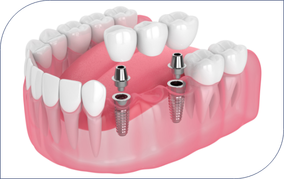 What Are Dental Implants?