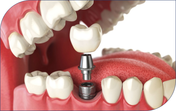 The Dental Implant Surgery Process