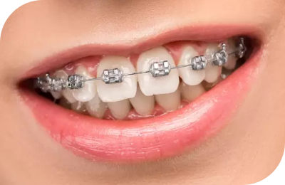 Traditional Braces