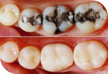 Features of Deep Bite